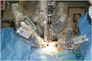 External-aspect-of-the-operative-field-DaVinci-robotic-system-docked-to-the-patient.jpg